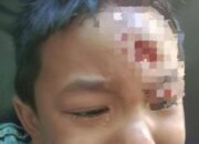 Kasus Gigitan Anjing HPR di Satar Mese, Balita 4 Tahun Jalani Perawatan dengan Serum Antirabies