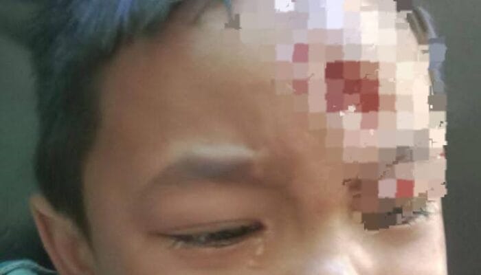 Kasus Gigitan Anjing HPR di Satar Mese, Balita 4 Tahun Jalani Perawatan dengan Serum Antirabies